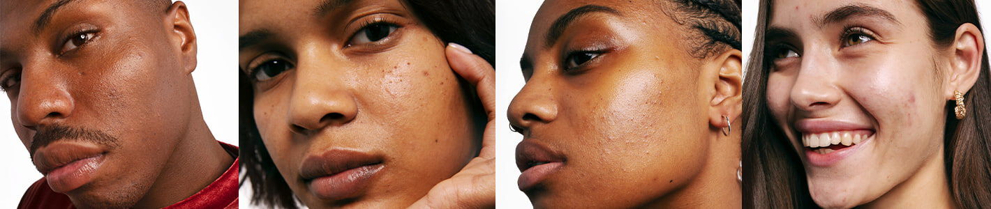 Soigner mon acné : quels soins anti imperfections et routine beauté